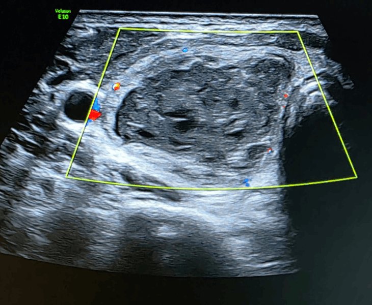 Aspiration of thyroid nodule