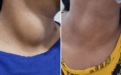 Thyroid treatment