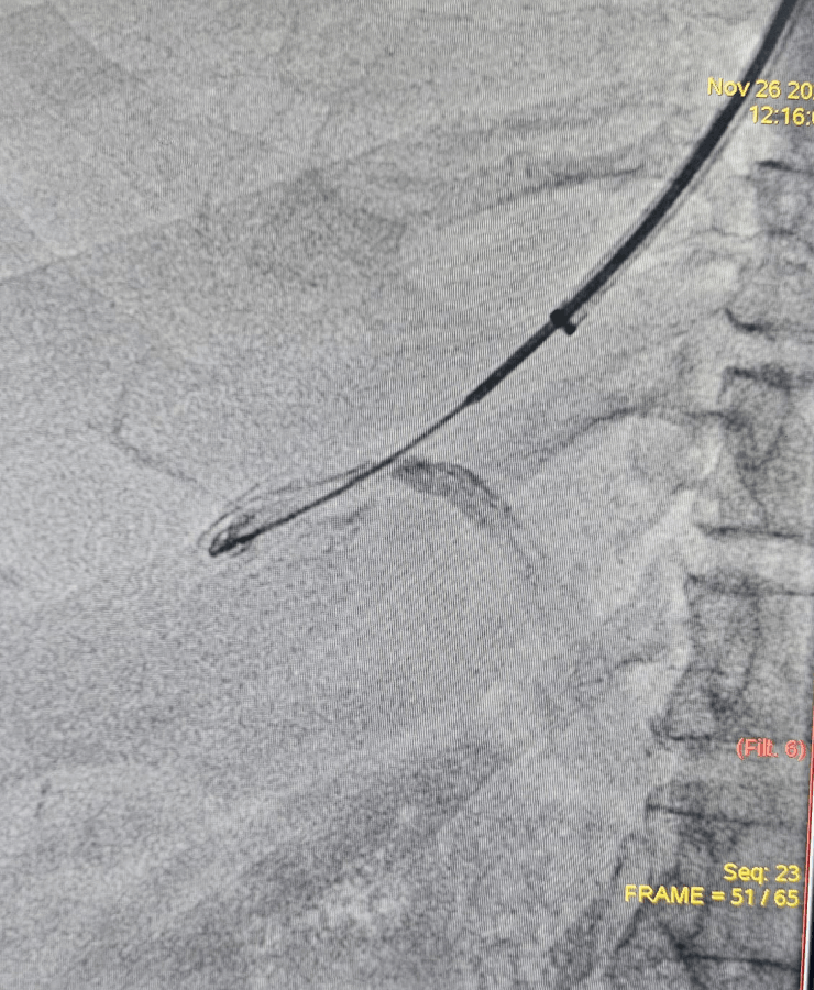 Embolization of splenic artery